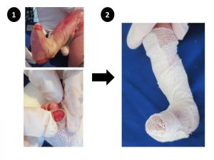 Primary dressing with modern wound dressing hydrocolloid, separation of toes, and secondary dressing with self-adherent tape elastomull.